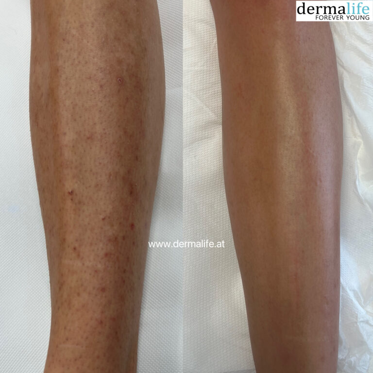 newhopenails-laser-haarentfernung-dermalife-beine-waden