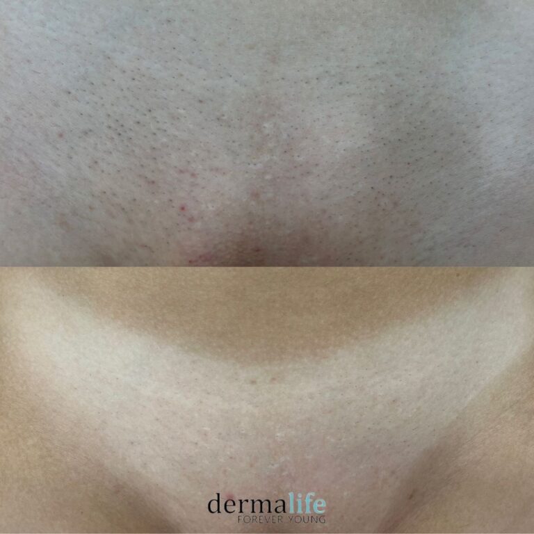 newhopenails-laser-haarentfernung-dermalife-intim-vorher-nachher-2