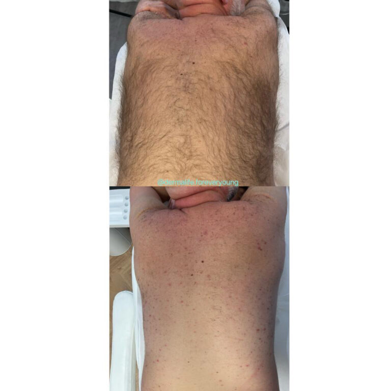 newhopenails-laser-haarentfernung-dermalife-ruecken-voher-nachher